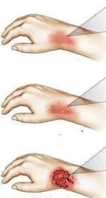 الأخطاء الشائعة في علاج الحروق