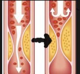 ما هو #الكولسترول (LDL ) ؟