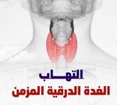 التهاب الغدة الدرقية المزمن