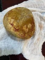 فريق طبي في مستشفى بعقوبة التعليمي ينهي معاناة مريض برفع حصوة من المثانة وزنها 1 كيلو غرام !