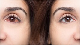 أسباب احمرار العين الناتج عن العدسات اللاصقة