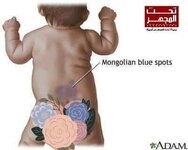 البقعة_المنغولية الزرقاء عند الاطفال