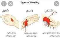 التمييز بين النزيف الشرياني والوريدي والشعيري