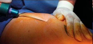 مخاطر شفط الدهون