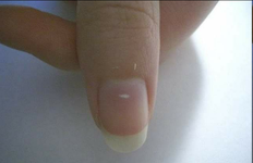 ماهي البقع البيضاء علي الاظافر..؟