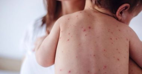 أسباب مرض الحصبة وطرق الوقاية منه