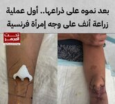 بعد نموه على ذراعها ..اول عملية زرع لأنف على وجه امرأة فرنسية