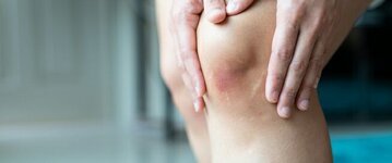 كيفية علاج كدمة الركبه
