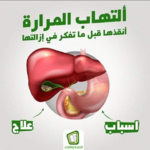 📌أسباب حصول الحصوات في المرارة
